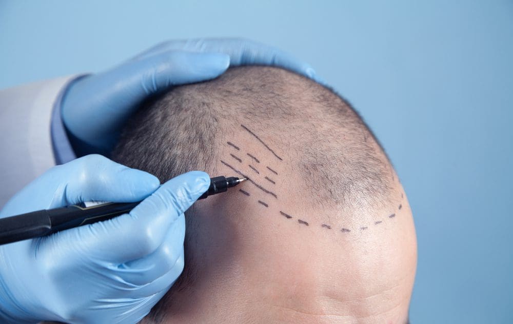 Restoring Confidence: The Advantages Of Hair Transplants In The UK